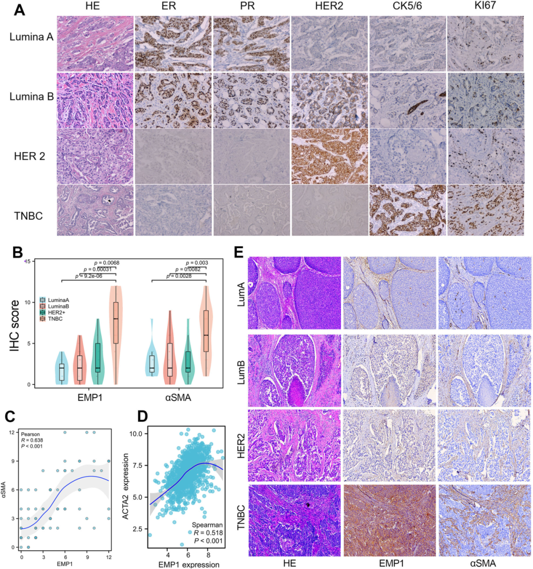 Figure 1. EMP1 is highly expressed in TNBC and correlates with CAF infiltration